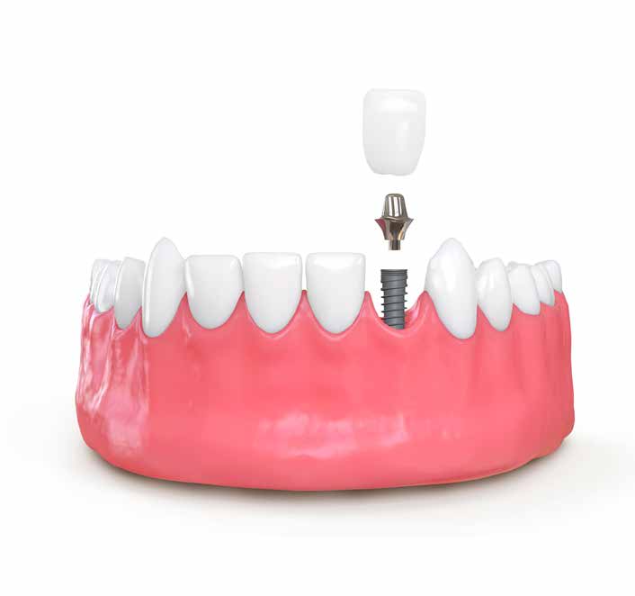 ID Implant kataloğundaki implantın çene modelindeki görünümü